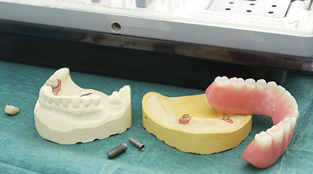Implantate in der Zahnarztpraxis